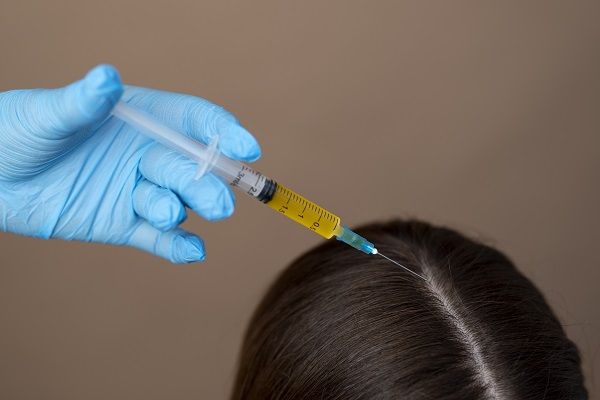 iniezione sul cuoio capelluto
