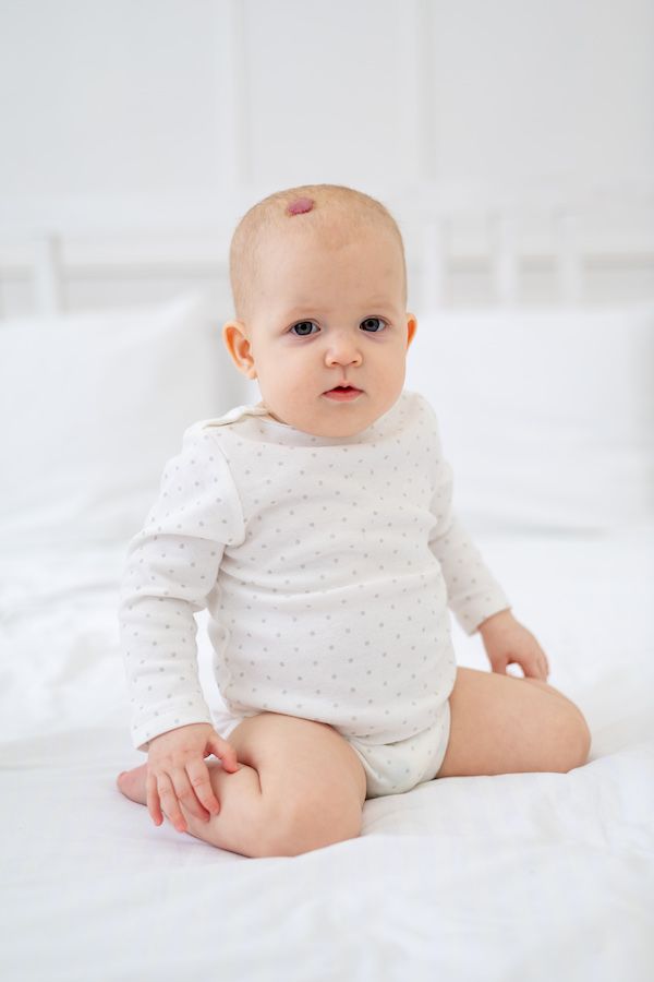 a baby girl of six months with a red hemangioma or a benign tumor on her head on a white cotton bed in a bodysuit on a bed at home