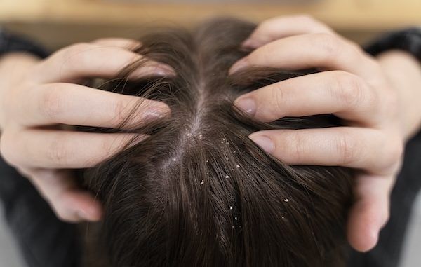capelli con forfora