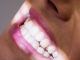 Paziente femminile che riceve un trattamento dentale