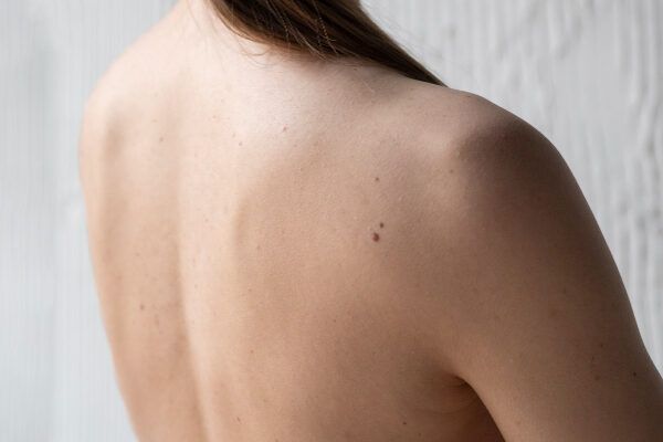 Cos'è un sarcoma? Condizioni nei tessuti molli della pelle.