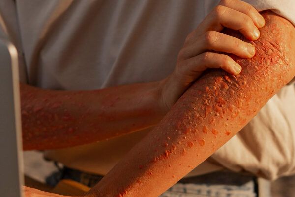 Intolleranza al glutine? 