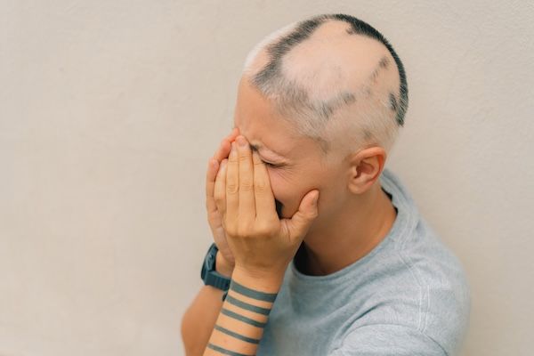 Alopecia areata reale in una bambina giovane Testa calva in una persona Alopecia diffusa
