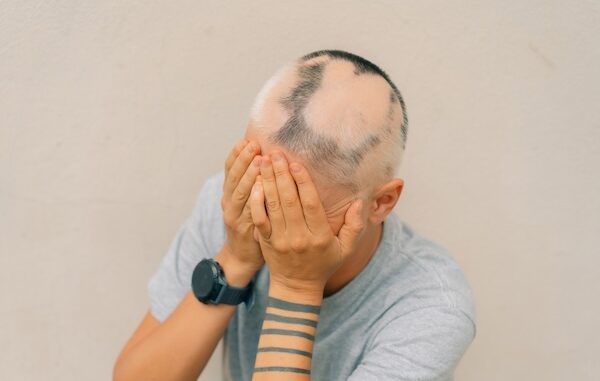 Alopecia areata reale in una bambina giovane Testa calva in una persona Alopecia diffusa