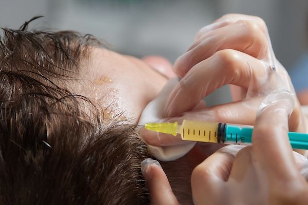 Iniezione di plasma nei capelli del cuoio capelluto uomo cosmetologo medico
