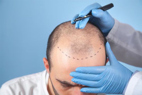 paziente affetto da perdita di capelli consulta il medico