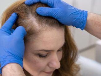 Trapianto capelli femminile