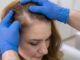 Trapianto capelli femminile