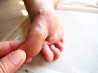 **Traduzione in italiano:** **Verruche plantari** Le verruche plantari sono verruche causate dal virus del papilloma umano (HPV). L'HPV si manifesta sulle piante dei piedi o sulle dita. Le lesioni sulla pianta del piede presentano papule dure e ruvide che distruggono i normali pattern cutanei delle impronte digitali.