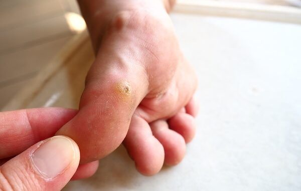 **Traduzione in italiano:** **Verruche plantari** Le verruche plantari sono verruche causate dal virus del papilloma umano (HPV). L'HPV si manifesta sulle piante dei piedi o sulle dita. Le lesioni sulla pianta del piede presentano papule dure e ruvide che distruggono i normali pattern cutanei delle impronte digitali.