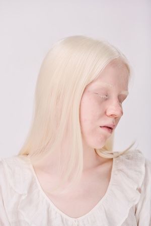 una donna albina