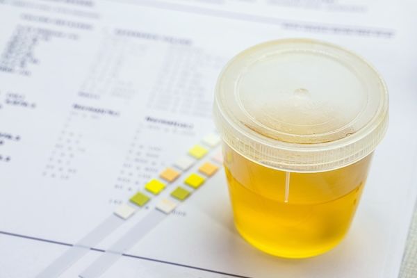 test delle urine per diagnosticare la clamidia