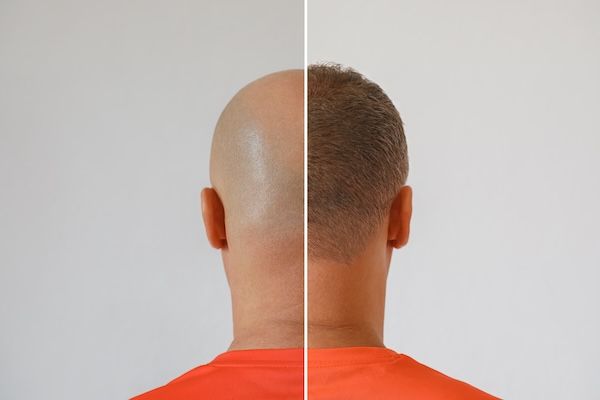 comparativo risultati del trapianto di capelli sulla testa di un paziente - risultati trapianto di capelli