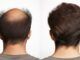 risultati trapianto di capelli