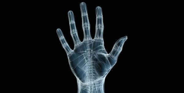 Una radiografia di una mano dove si possono vedere tutte le ossa, radiografia della mano umana per una frattura scafoide non curata