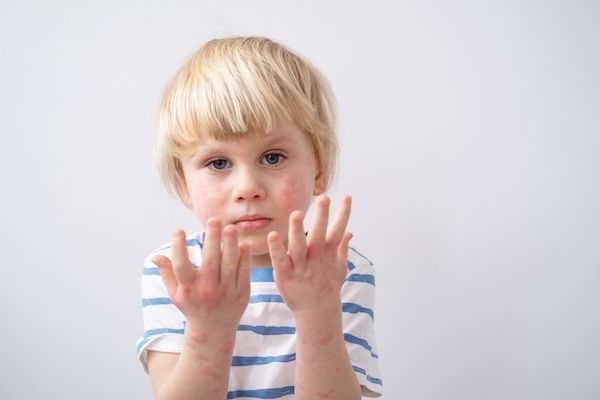bambino con problemi infantili della pelle su sfondo bianco.