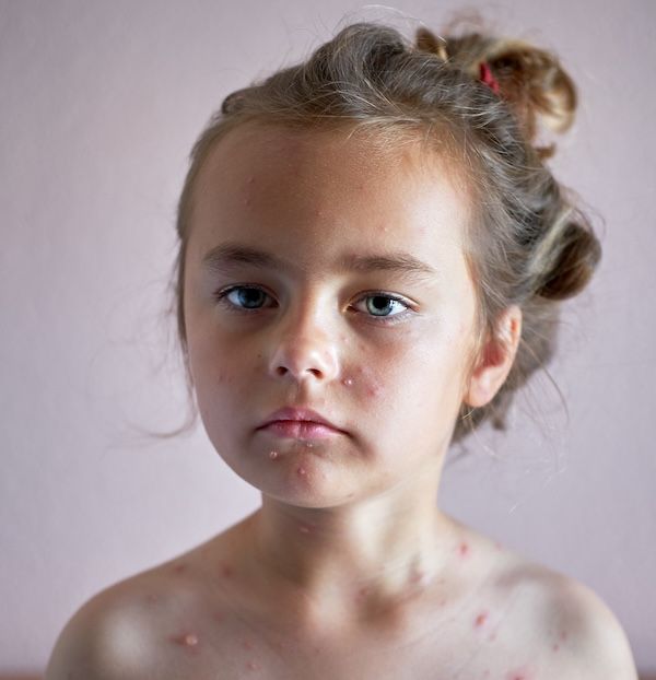 ritratto di una bambina senza maglietta che soffre di varicella malattie infantili della pelle