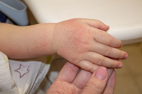 Macchie rosse sulla pelle delle mani di un bambino Allergia infantile Secchezza e irritazione della pelle malattie infantili della pelle