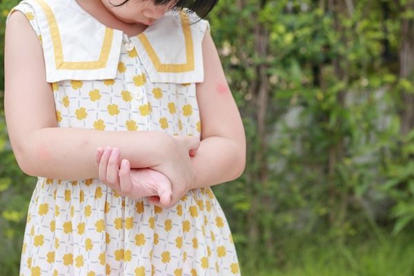 La bambina ha un'eruzione cutanea, allergia, prurito e si gratta il braccio. malattie infantili della pelle