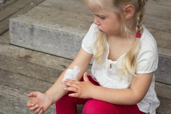 La bambina ha un'eruzione cutanea, allergia, prurito e si gratta il braccio. malattie infantili della pelle