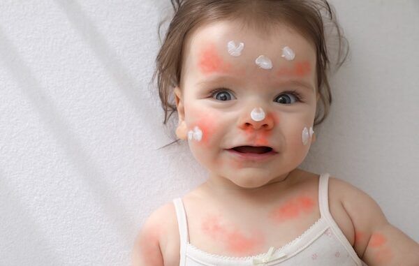 Dolce bebè con crema antiallergica sul viso nella parte superiore della culla malattie infantili della pelle arrossamento della pelle."