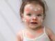 Dolce bebè con crema antiallergica sul viso nella parte superiore della culla malattie infantili della pelle arrossamento della pelle."