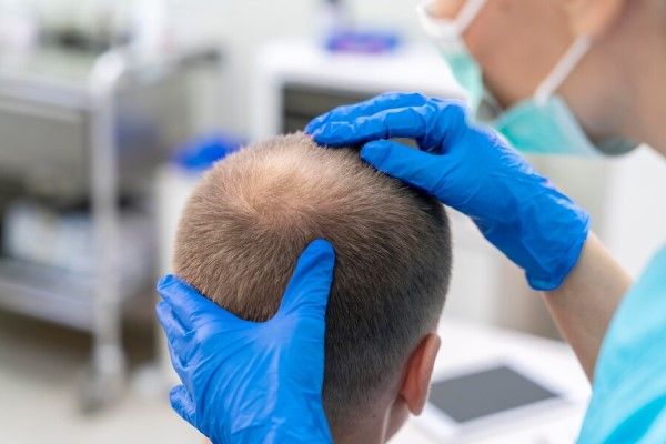 uomo adulto con problemi di calvizie, controllato da un professionista - miglior trapianto capelli Italia