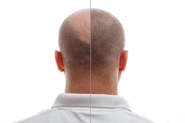  immagine prima e dopo la corona di un paziente sottoposto a trapianto di capelli - postoperatorio trapianto capelli