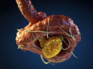 Tumori-benigni-o-non-cancerosi