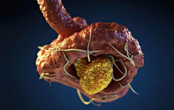 Tumori-benigni-o-non-cancerosi