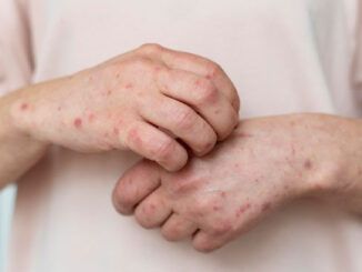 Morbillo-sintomi-e-trattamento
