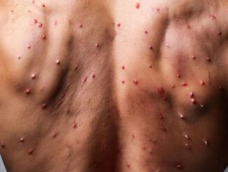 Varicella-e-morbillo-quali-sono-le-differenze