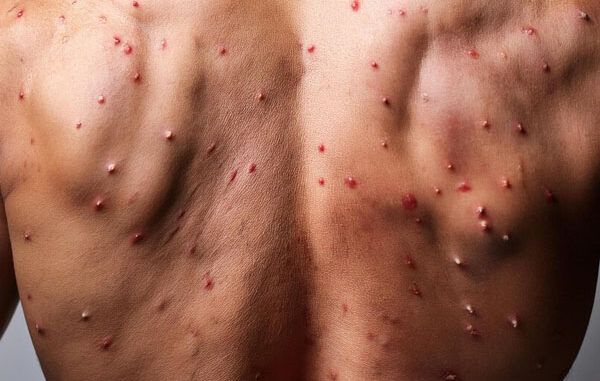 Varicella-e-morbillo-quali-sono-le-differenze