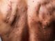 Varicella-e-morbillo-quali-sono-le-differenze