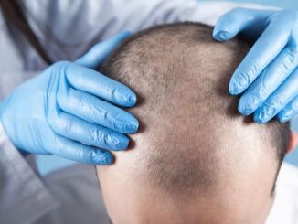 richieste trapianto capelli