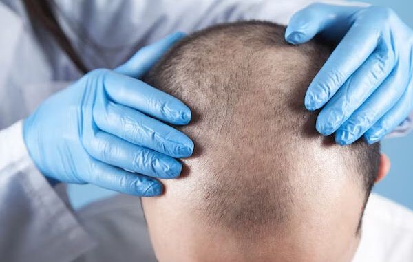 richieste trapianto capelli