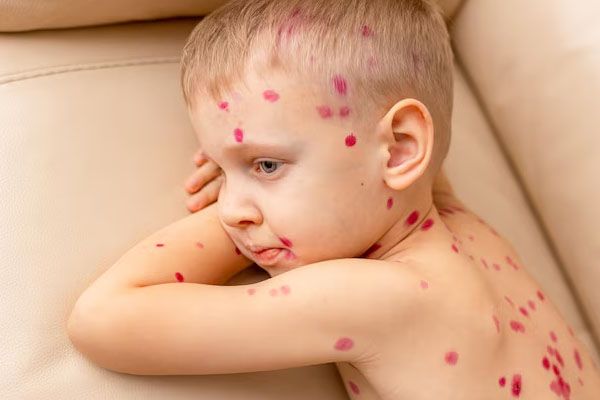 Bambino-con-la-varicella-che-riposa-sul-divano-in-un- ambiente-interno-confortevole