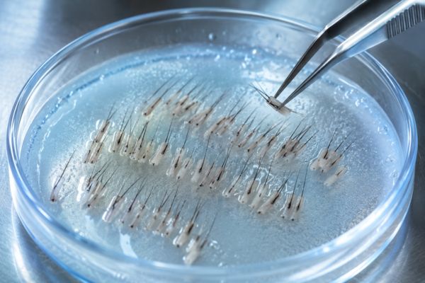 Innesti di capelli singoli e multipli posizionati all'interno di una capsula di Petri con liquido refrigerante refrigerato di conservazione biologica