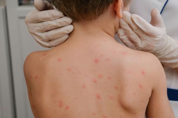 Il medico applica una crema sulla pelle del bambino per vesciche ed eruzioni cutanee causate dalla varicella