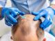 infiammazione trapianto capelli