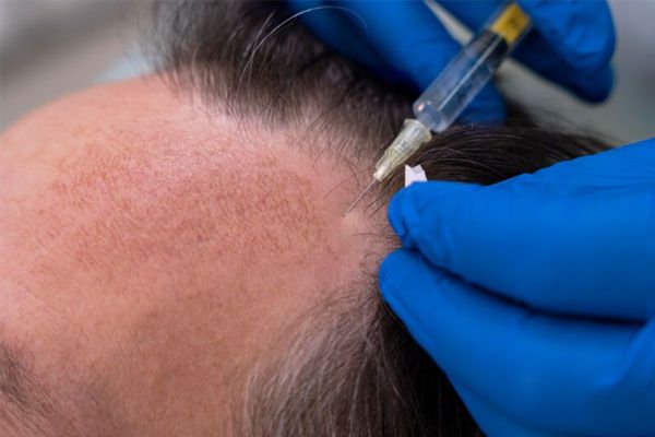 Primo piano di un uomo sottoposto a trattamento per la caduta dei capelli