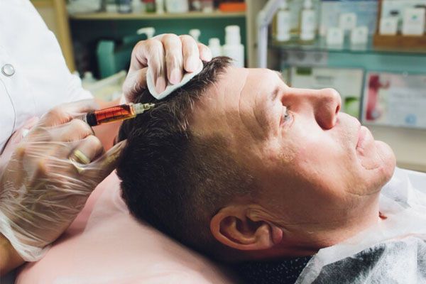 l'estetista indossa i guanti eseguendo un iniezione sottocutanea su un paziente maschio - pianificare trapianto capelli 
