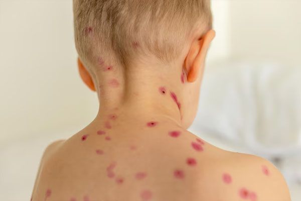 malattia infantile pelle con macchie sulla schiena e sul collo