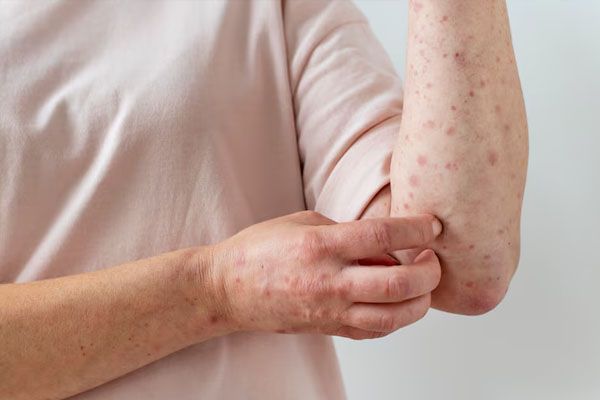 persona con allergia cutanea al braccio