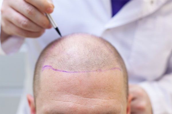 preparazione all'intervento di trapianto di capelli - Trapianto capelli FUE 