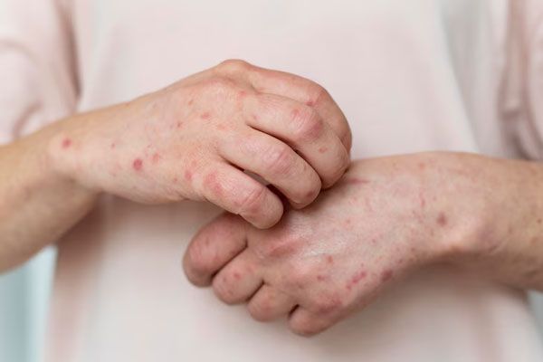 primo piano delle mani di una persona con malattia della pelle