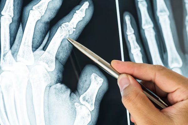 radiografia ravvicinata dito fratturato