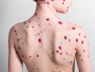varicella