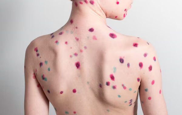 varicella