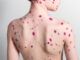 varicella